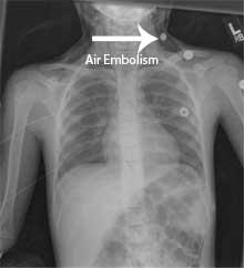 air embolism
