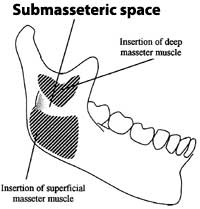 submasseteric space
