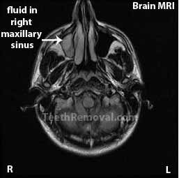 fluid in right maxillary sinus