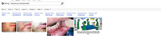 thermal burn wisdom teeth bing - The Search Engine Battle: Are you Paying Attention?