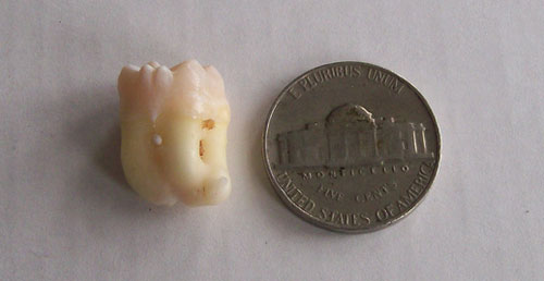 third molar nickel