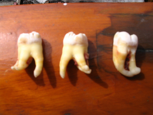 three wisdom teeth