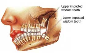 wisdom teeth removal