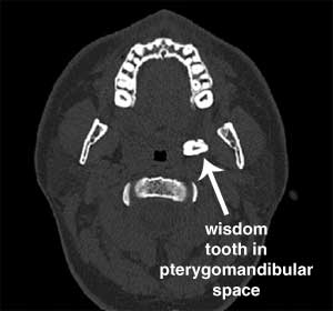 wisdom tooth pterygomandibular space